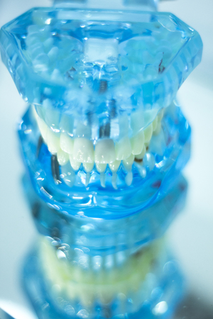 Dental teeth orthodontic dentistry teachng model with gums, tooth enamel, plaque, roots and metal implants.の写真素材