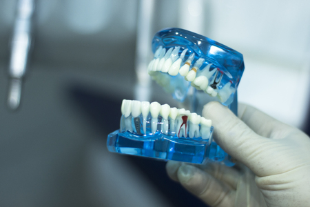 Dental teeth orthodontic dentistry teachng model with gums, tooth enamel, plaque, roots and metal implants.の写真素材