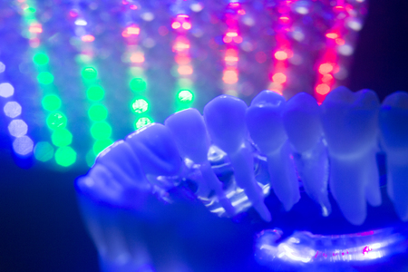 Dental teeth orthodontic dentistry teachng model with gums, tooth enamel, plaque, roots and metal implants.の写真素材