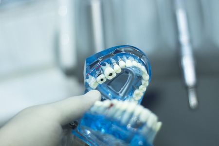 Dental teeth orthodontic dentistry teachng model with gums, tooth enamel, plaque, roots and metal...
