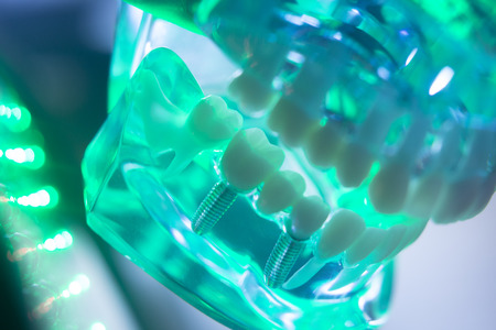 Dental teeth orthodontic dentistry teachng model with gums, tooth enamel, plaque, roots and metal implants.の写真素材