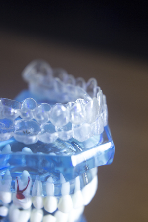 Dental teeth orthodontic dentistry teachng model with gums, tooth enamel, plaque, roots and metal implants.の写真素材