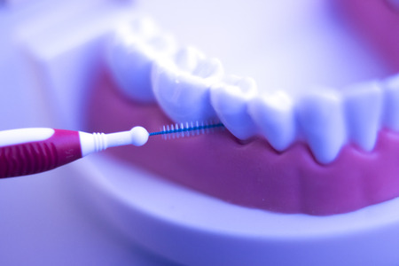 Dental teeth orthodontic dentistry teachng model with gums, tooth enamel, plaque, roots and metal implants.の写真素材