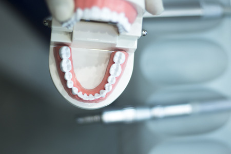 Dental teeth orthodontic dentistry teachng model with gums, tooth enamel, plaque, roots and metal implants.の写真素材