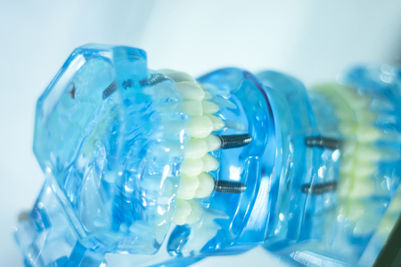 Dental teeth orthodontic dentistry teachng model with gums, tooth enamel, plaque, roots and metal...