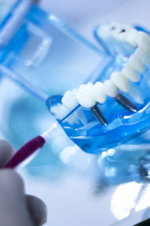 Dental teeth orthodontic dentistry teachng model with gums, tooth enamel, plaque, roots and metal implants.の写真素材