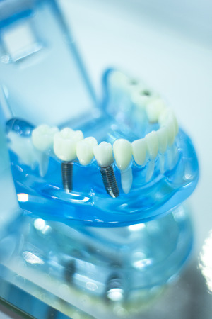Dental teeth orthodontic dentistry teachng model with gums, tooth enamel, plaque, roots and metal...