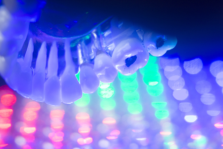 Dental teeth orthodontic dentistry teachng model with gums, tooth enamel, plaque, roots and metal implants.の写真素材