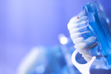 Dental teeth orthodontic dentistry teachng model with gums, tooth enamel, plaque, roots and metal implants.の写真素材
