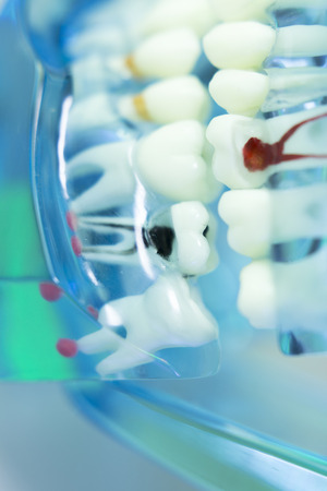 Dental teeth, mouth, gums dentists teaching model showing each tooth and root canal decay and inflamation.の写真素材