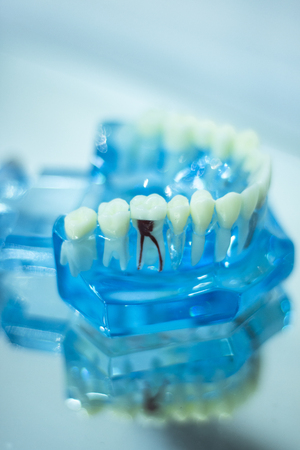 Dental teeth orthodontic dentistry teachng model with gums, tooth enamel, plaque, roots and metal implants.の写真素材