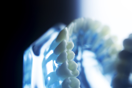 Dental teeth orthodontic dentistry teachng model with gums, tooth enamel, plaque, roots and metal...