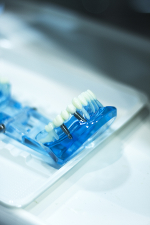 Dental teeth orthodontic dentistry teachng model with gums, tooth enamel, plaque, roots and metal implants.の写真素材