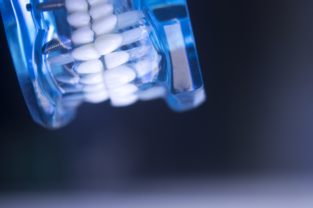 Dental teeth orthodontic dentistry teachng model with gums, tooth enamel, plaque, roots and metal implants.の写真素材