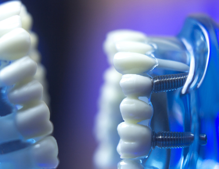 Dental teeth orthodontic dentistry teachng model with gums, tooth enamel, plaque, roots and metal...