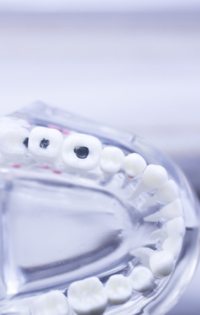 Dental teeth mouth dentists teaching model with teeth, gums, molars and wisdom tooth.