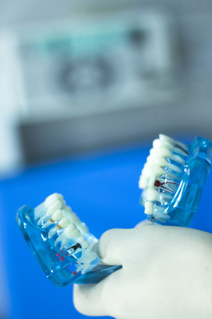 Dental teeth orthodontic dentistry teachng model with gums, tooth enamel, plaque, roots and metal...