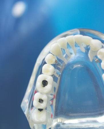 Dental teeth mouth dentists teaching model with teeth, gums, molars and wisdom tooth.