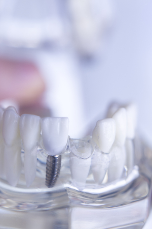 Dentsts dental prosthetic teeth, gums, roots teaching student model with gap in front teeth.