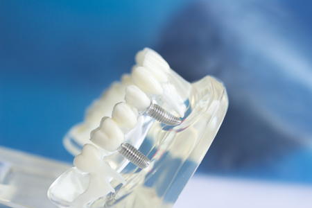 Dental teeth mouth dentists teaching model with teeth, gums, molars and wisdom tooth.