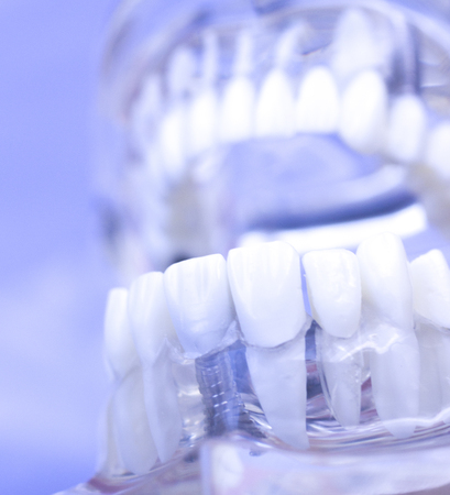 Dental teeth mouth dentists teaching model with teeth, gums, molars and wisdom tooth.