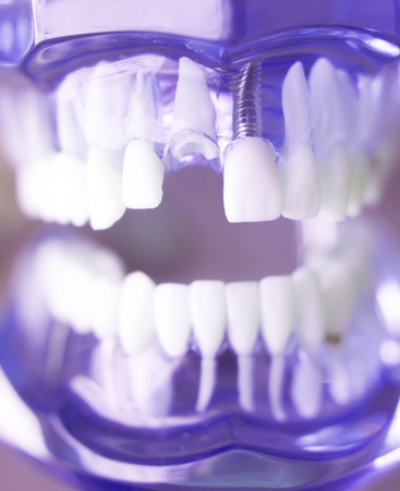 Dentsts dental prosthetic teeth, gums, roots teaching student model with gap in front teeth.