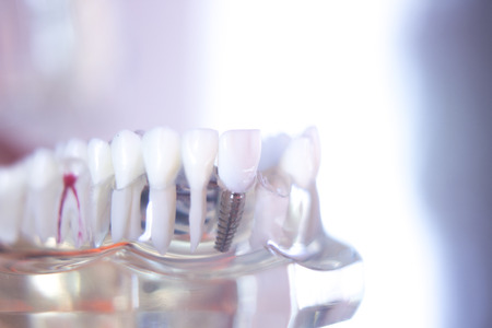 Dentsts dental prosthetic teeth, gums, roots teaching student model with gap in front teeth.