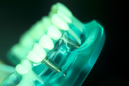 Dentsts dental prosthetic teeth, gums, roots teaching student model with titanium metal screw implant.の写真素材
