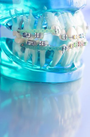 Dental teeth retainers metal aligners brackets to straighten teeth in orthodontic dentistry treatments.の写真素材