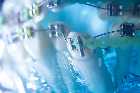 Dental teeth retainers metal aligners brackets to straighten teeth in orthodontic dentistry treatments.の写真素材