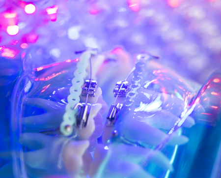 Dental teeth retainers metal aligners brackets to straighten teeth in orthodontic dentistry treatments.の写真素材