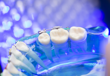 Dental teeth retainers metal aligners brackets to straighten teeth in orthodontic dentistry...