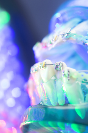 Dental teeth retainers metal aligners brackets to straighten teeth in orthodontic dentistry treatments.の写真素材