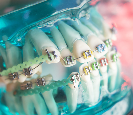Dental teeth retainers metal aligners brackets to straighten teeth in orthodontic dentistry treatments.の写真素材