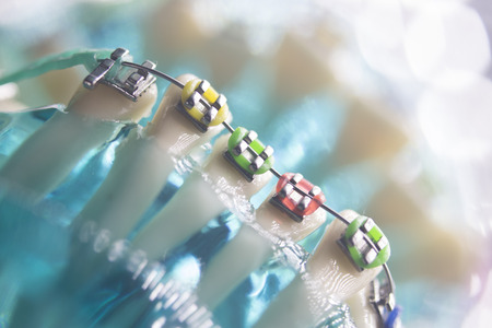 Dental teeth retainers metal aligners brackets to straighten teeth in orthodontic dentistry...