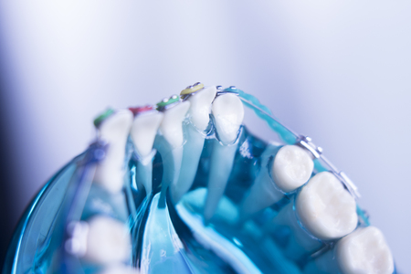 Dental teeth retainers metal aligners brackets to straighten teeth in orthodontic dentistry treatments.の写真素材