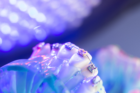 Dental teeth retainers metal aligners brackets to straighten teeth in orthodontic dentistry treatments.の写真素材