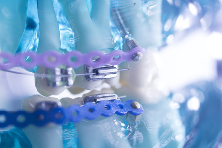 Dental teeth retainers metal aligners brackets to straighten teeth in orthodontic dentistry...