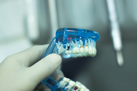 Dental teeth orthodontic dentistry teachng model with gums, tooth enamel, plaque, roots and metal...