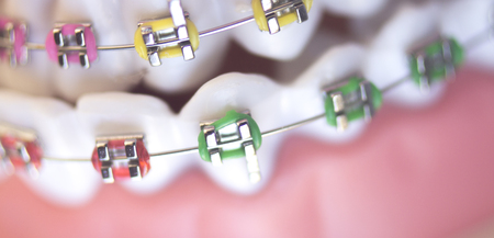 Cosmetic dentistry orthodontics dental metal wire teeth brackets teaching student model.