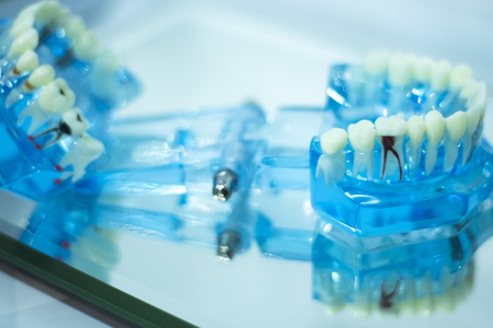 Dental teeth orthodontic dentistry teachng model with gums, tooth enamel, plaque, roots and metal implants.の写真素材