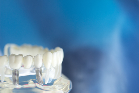 Dental teeth mouth dentists teaching model with teeth, gums, molars and wisdom tooth.