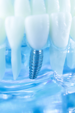 Dental titanium aesthetic orthodontic tooth implant in dentists mouth teeth model closeup isolated.の写真素材