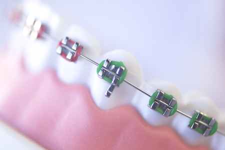 Cosmetic dentistry orthodontics dental metal wire teeth brackets teaching student model.の写真素材