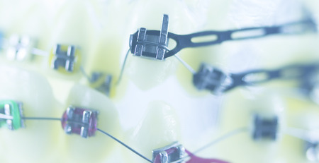 Orthodontics dentists teaching model dental teeth plastic and metal brackets aligners to straighten...