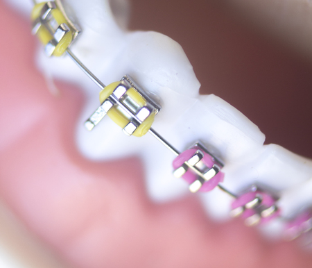 Cosmetic dentistry orthodontics dental metal wire teeth brackets teaching student model.の写真素材