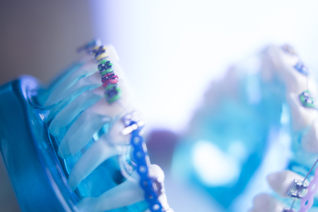 Dental teeth retainers metal aligners brackets to straighten teeth in orthodontic dentistry treatments.の写真素材