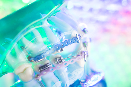 Dental teeth retainers metal aligners brackets to straighten teeth in orthodontic dentistry treatments.の写真素材