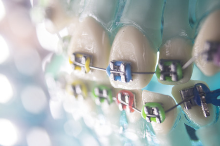 Dental teeth retainers metal aligners brackets to straighten teeth in orthodontic dentistry treatments.の写真素材
