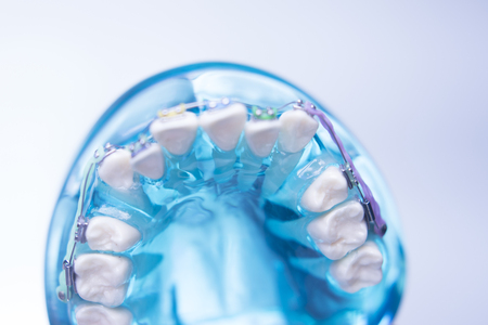 Dental teeth retainers metal aligners brackets to straighten teeth in orthodontic dentistry treatments.の写真素材